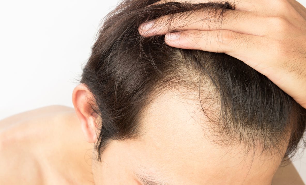 Perdida de cabello masculina