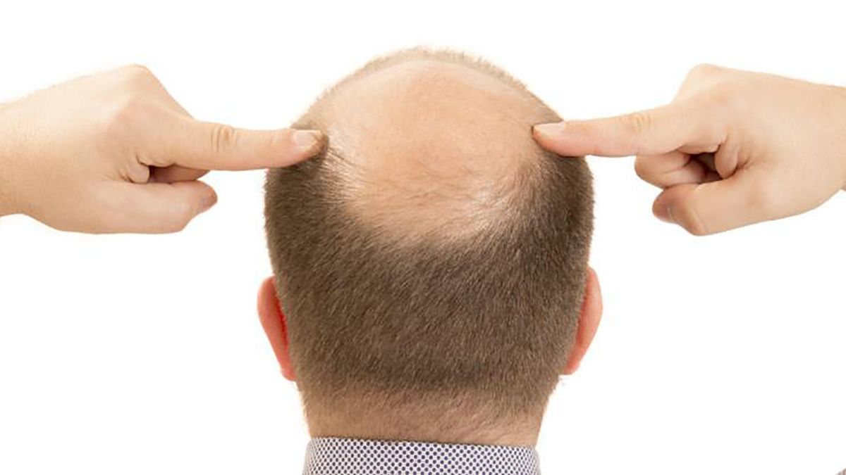 Alopecia